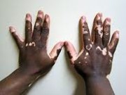 O que é Vitiligo?