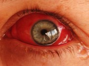 Alergia nos Olhos- Quais são os Sintomas? Como Tratar e Prevenir?